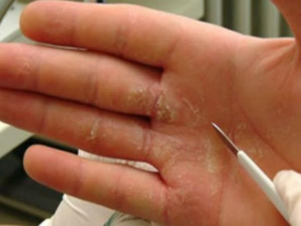 Ali veste, kateri so prvi simptomi raka, ki se najprej kažejo na rokah?